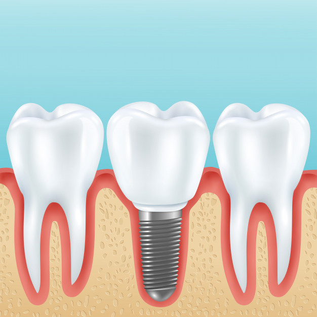 Trồng răng implant