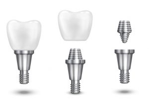 Trụ Implant và khớp nối Abutment