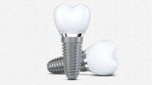 Giá Trụ Implant Khác Nhau Do Đâu?