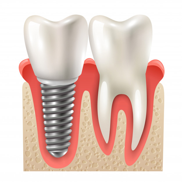 Răng Implant và Răng Thường