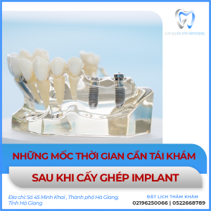 Mốc Thời Gian Tái Khám Sau Khi Cấy Ghép Implant