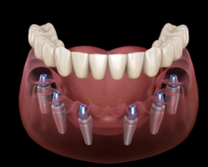 Trồng răng implant toàn hàm