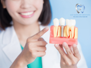 Điều cần biết khi trồng răng Implant