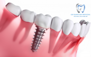 Cấy Ghép Implant và những điều cần biết