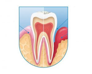 Viêm cuống răng và cách điều trị