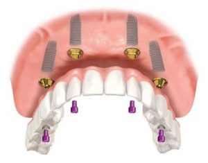 Trồng răng nguyên hàm bằng phương pháp all-on-4