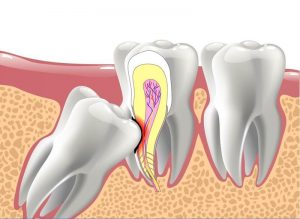 Răng Khôn Mọc Ngầm Và Những Nguy Cơ Tiềm Ẩn