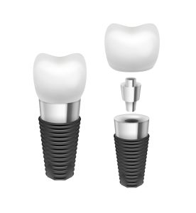 Sau cấy ghép implant cần làm gì