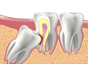 Răng 8 Mọc Ngầm Và Những Nguy Cơ Tiềm Ẩn