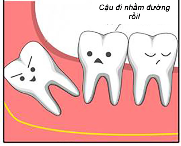 Nhận diện các kiểu răng khôn