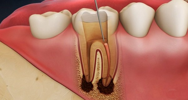 Điều trị tủy răng an toàn